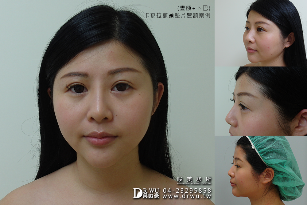 【卡麥拉Goretex豐額】飽滿額頭,可愛滿分|台中內視鏡豐額|峻美診所