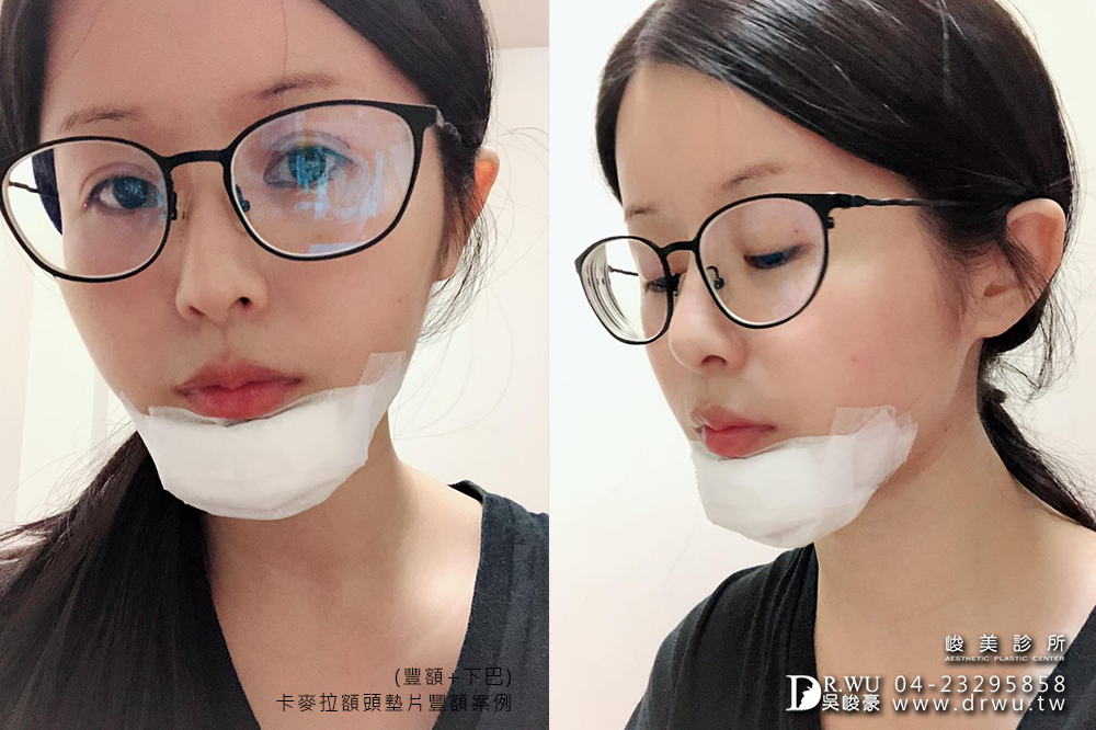 【卡麥拉Goretex豐額】飽滿額頭,可愛滿分|台中內視鏡豐額|峻美診所