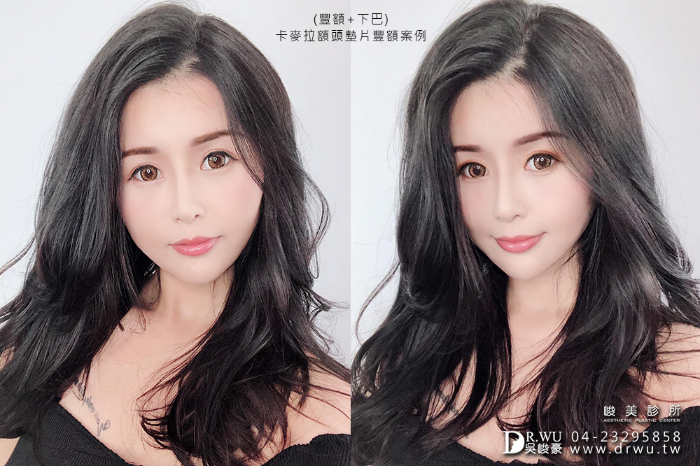 【卡麥拉Goretex豐額】飽滿額頭,可愛滿分|台中內視鏡豐額|峻美診所