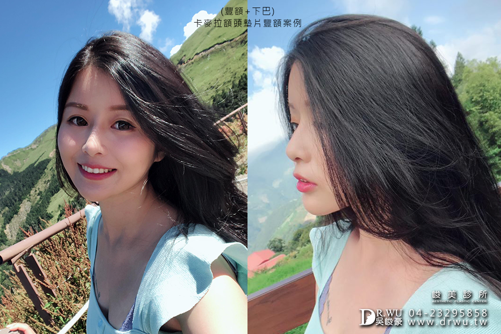 【卡麥拉Goretex豐額】飽滿額頭,可愛滿分|台中內視鏡豐額|峻美診所