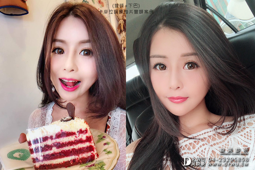 【卡麥拉Goretex豐額】飽滿額頭,可愛滿分|台中內視鏡豐額|峻美診所