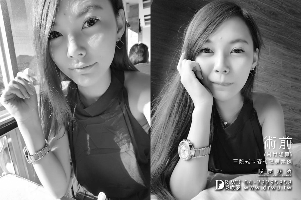【隆鼻推薦】三段式隆鼻台中首選,隆鼻手術之神吳峻豪醫師|峻美診所