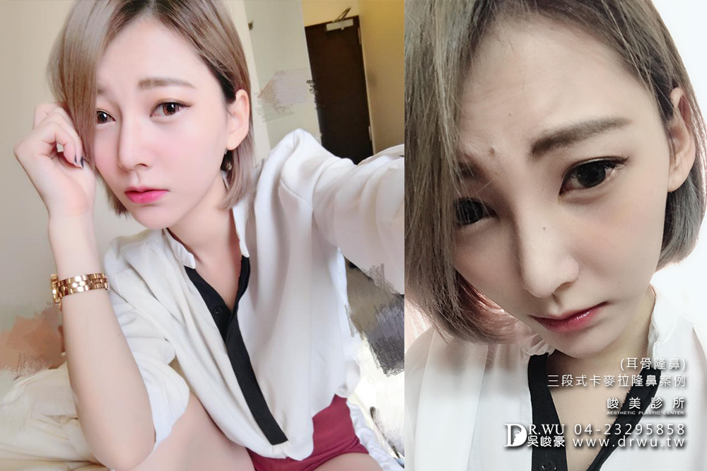 【隆鼻推薦】三段式隆鼻台中首選,隆鼻手術之神吳峻豪醫師|峻美診所