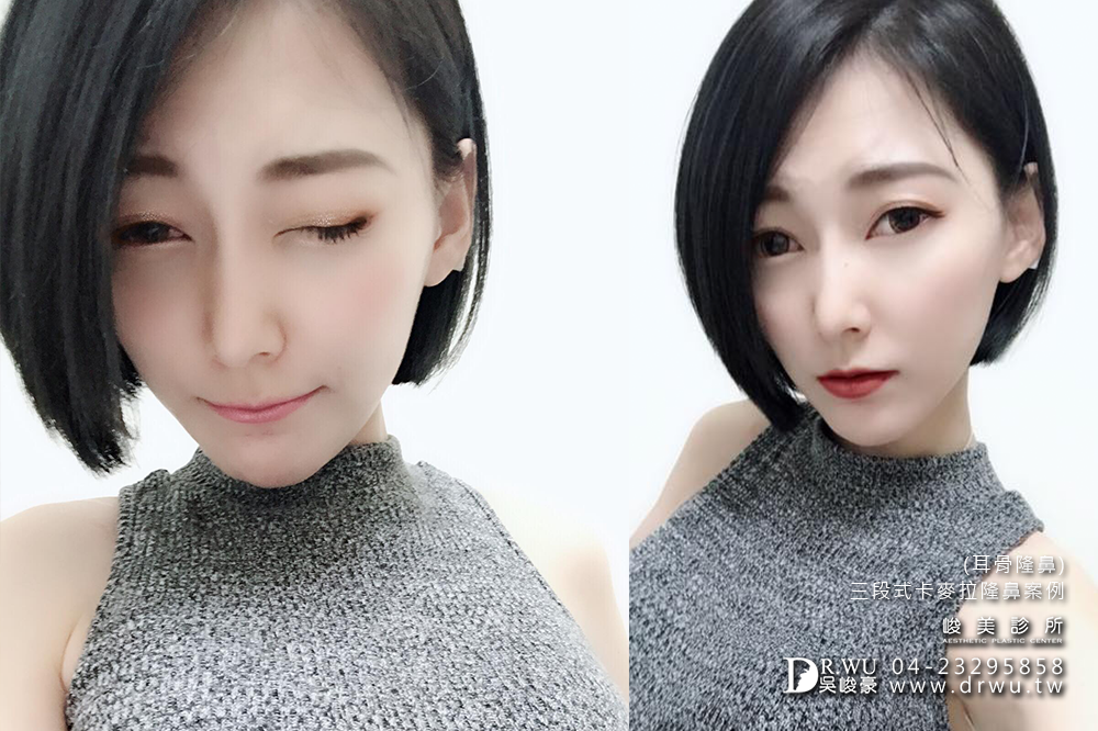 【隆鼻推薦】三段式隆鼻台中首選,隆鼻手術之神吳峻豪醫師|峻美診所