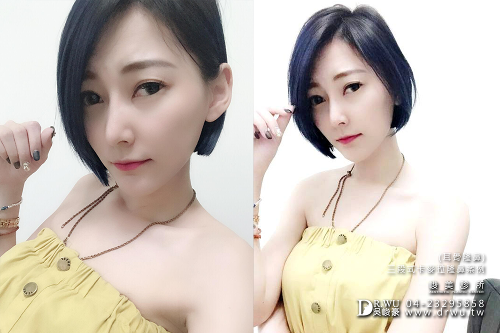 想要隆鼻台中峻美診所是你唯一首選!!!