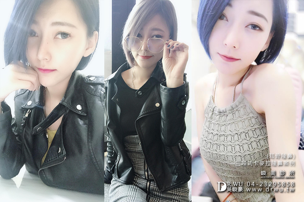 -隆鼻手術/隆鼻推薦/隆鼻台中峻美診所-