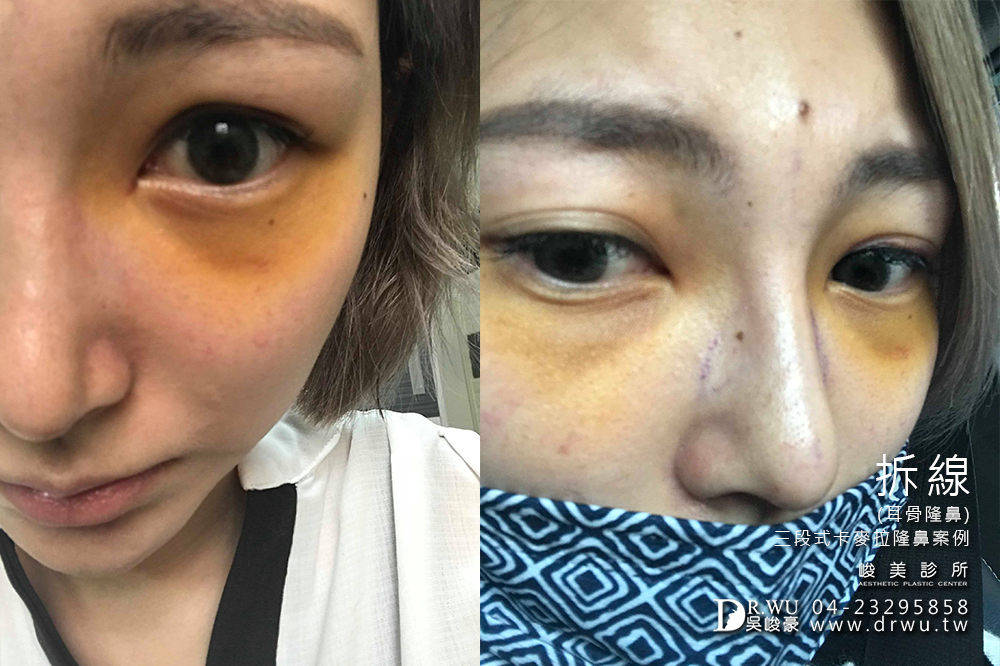 【隆鼻推薦】三段式隆鼻台中首選,隆鼻手術之神吳峻豪醫師|峻美診所