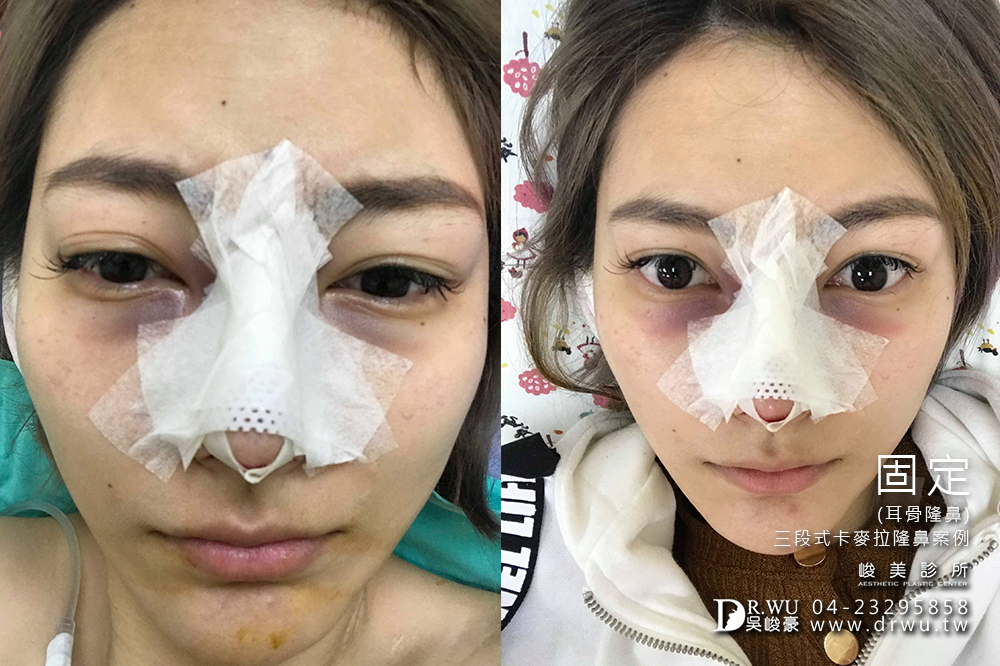 【隆鼻推薦】三段式隆鼻台中首選,隆鼻手術之神吳峻豪醫師|峻美診所