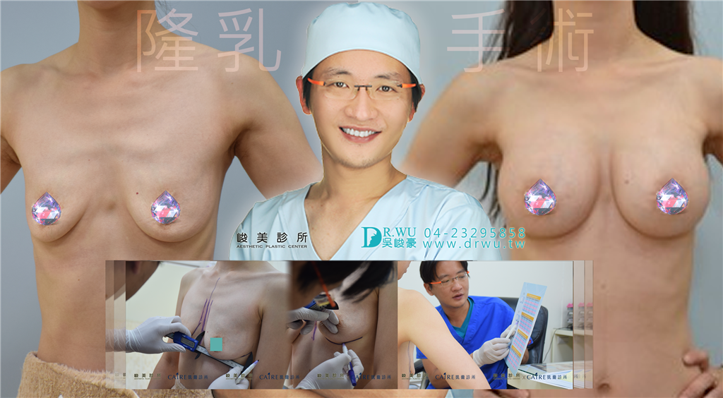 台中隆乳手術│台中隆乳手術推薦