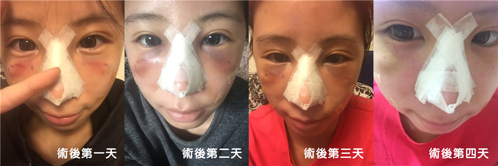 台中隆鼻-恢復期中-峻美診所