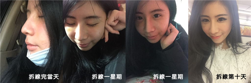 台中隆鼻-拆線後恢復期-峻美診所