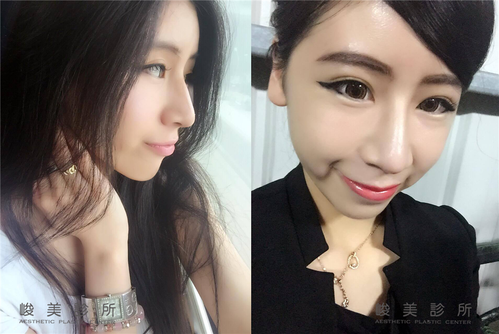 台中隆鼻-隆鼻完成囉-峻美診所