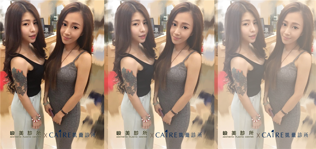 隆鼻隆乳精緻我的美麗
