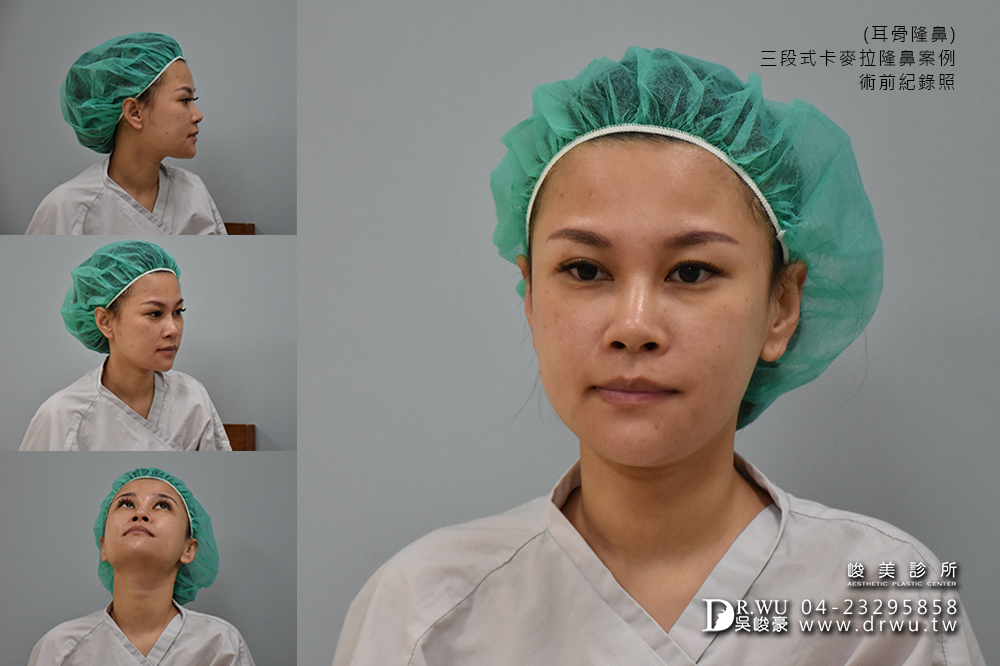 【Goretex卡麥拉三段式隆鼻】改變鼻骨寬敲鼻骨隆鼻,創造精緻美型鼻|峻美診所