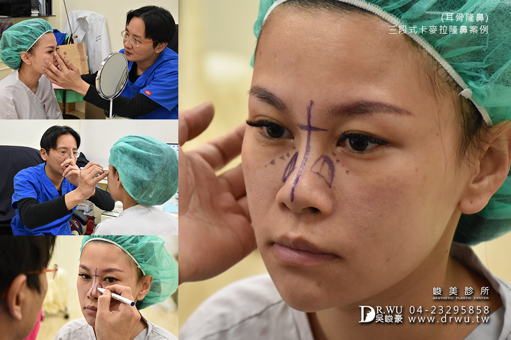 【Goretex卡麥拉三段式隆鼻】改變鼻骨寬敲鼻骨隆鼻,創造精緻美型鼻|峻美診所