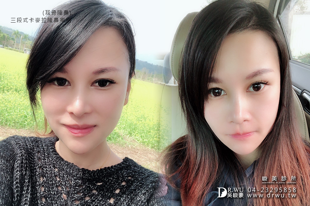 【Goretex卡麥拉三段式隆鼻】改變鼻骨寬敲鼻骨隆鼻,創造精緻美型鼻|峻美診所