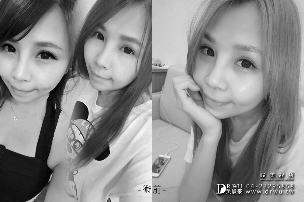 【台中豐額手術】女神分享前額植入卡麥拉材質+卡麥拉下巴+三段式卡麥拉隆鼻!!