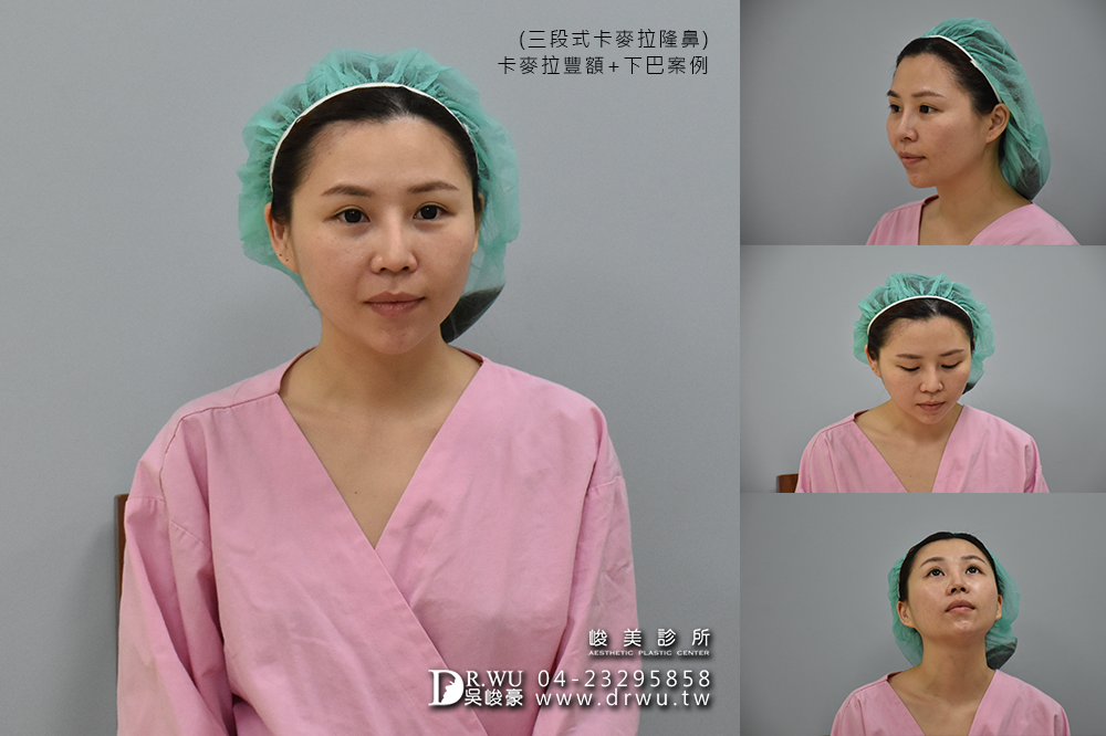 【台中豐額手術】女神分享前額植入卡麥拉材質+卡麥拉下巴+三段式卡麥拉隆鼻!!