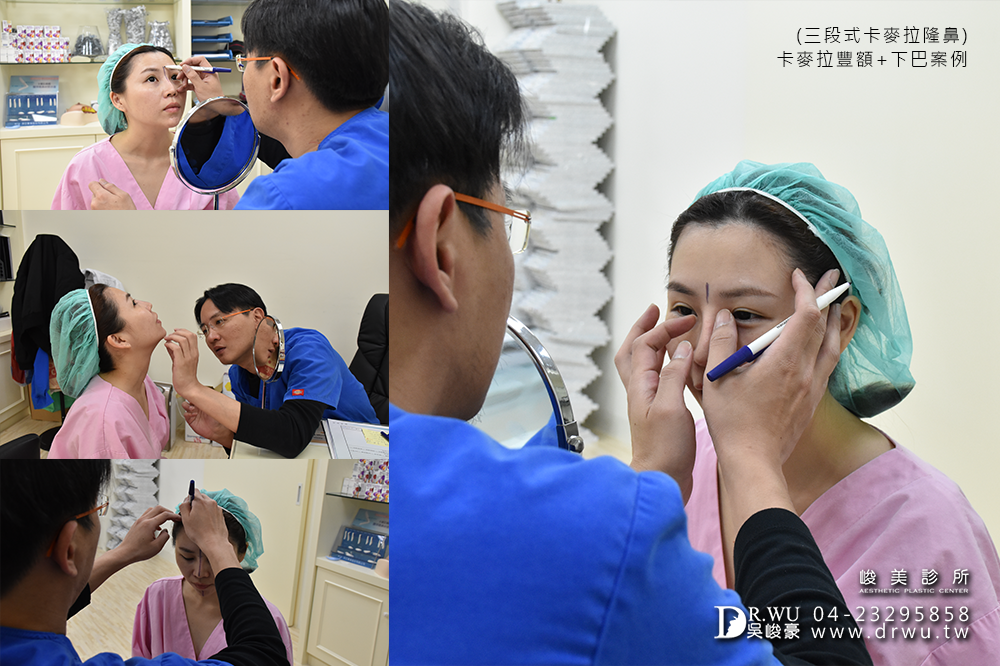 【台中豐額手術】女神分享前額植入卡麥拉材質+卡麥拉下巴+三段式卡麥拉隆鼻!!