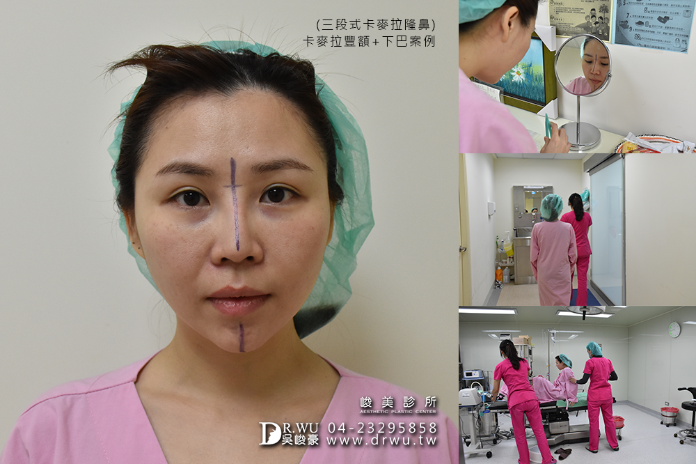 【台中豐額手術】女神分享前額植入卡麥拉材質+卡麥拉下巴+三段式卡麥拉隆鼻!!