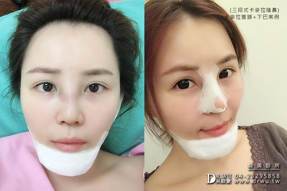【台中豐額手術】女神分享前額植入卡麥拉材質+卡麥拉下巴+三段式卡麥拉隆鼻!!