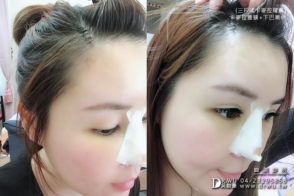 【台中豐額手術】女神分享前額植入卡麥拉材質+卡麥拉下巴+三段式卡麥拉隆鼻!!