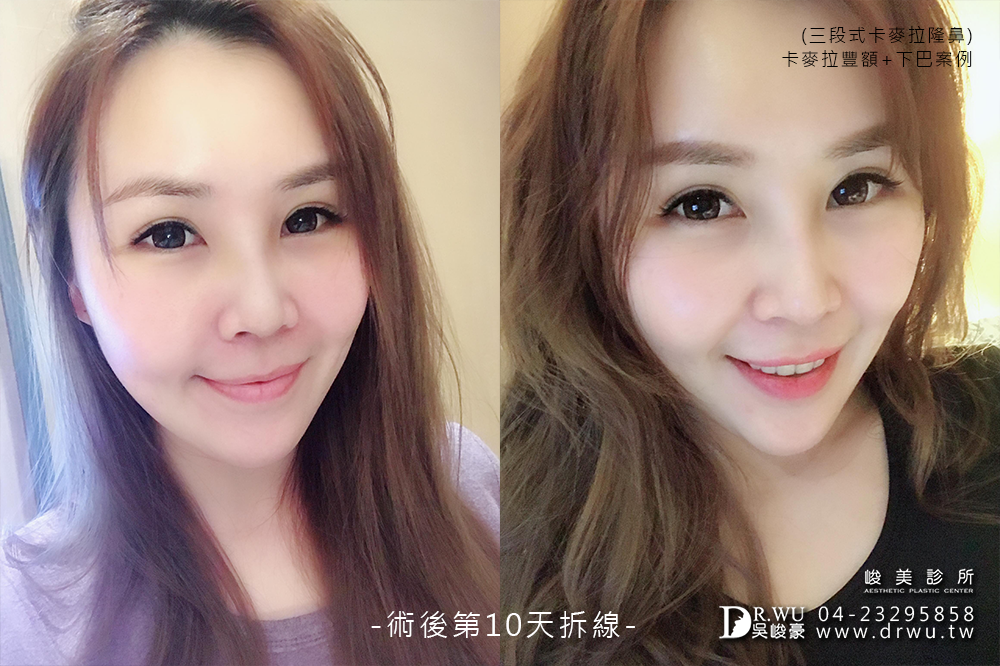 【台中豐額手術】女神分享前額植入卡麥拉材質+卡麥拉下巴+三段式卡麥拉隆鼻!!