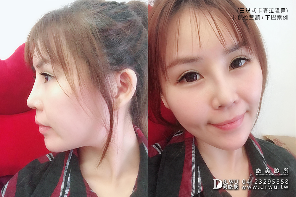 【台中豐額手術】女神分享前額植入卡麥拉材質+卡麥拉下巴+三段式卡麥拉隆鼻!!