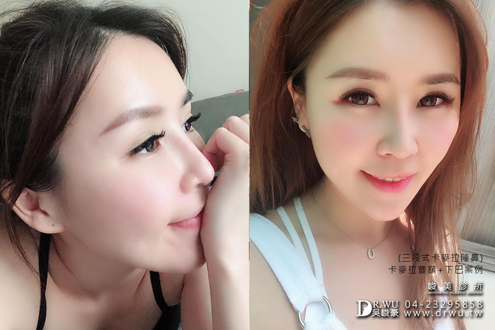 【台中豐額手術】女神分享前額植入卡麥拉材質+卡麥拉下巴+三段式卡麥拉隆鼻!!