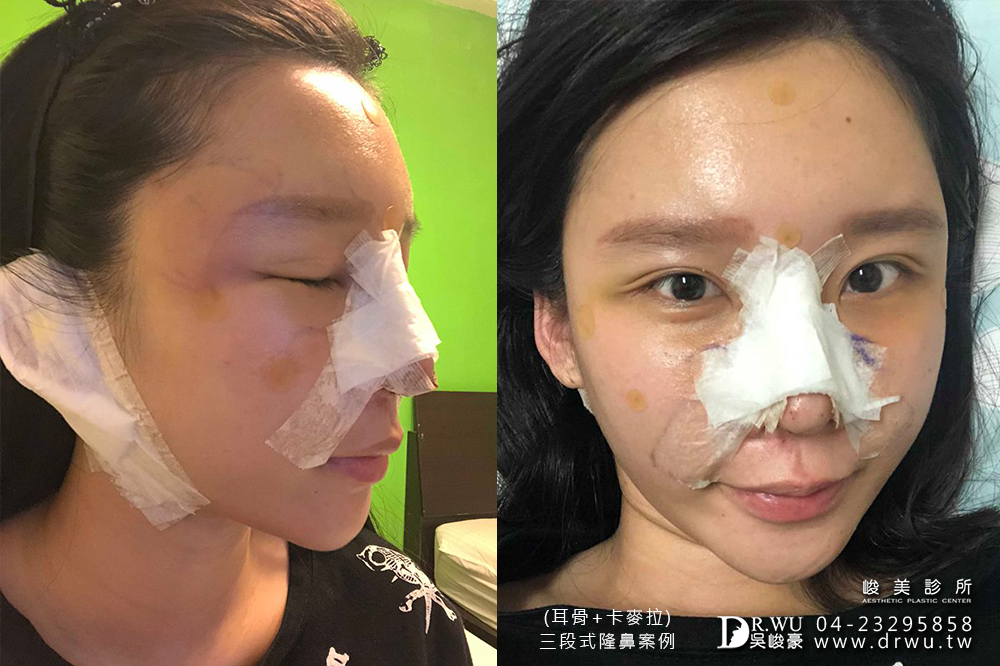 【三段式卡麥拉隆鼻】韓式隆鼻+自體耳軟骨隆鼻,創造亞洲美鼻~|臉部自體脂肪補脂|峻美診所