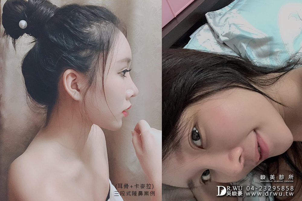 【三段式卡麥拉隆鼻】韓式隆鼻+自體耳軟骨隆鼻,創造亞洲美鼻~|臉部自體脂肪補脂|峻美診所