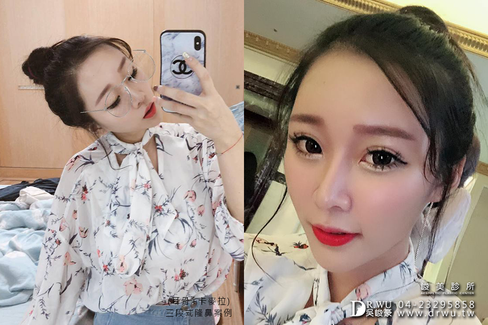 【三段式卡麥拉隆鼻】韓式隆鼻+自體耳軟骨隆鼻,創造亞洲美鼻~|臉部自體脂肪補脂|峻美診所