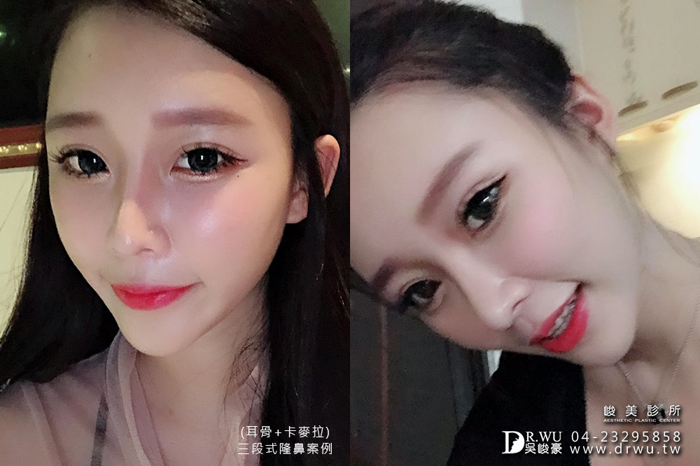 【三段式卡麥拉隆鼻】韓式隆鼻+自體耳軟骨隆鼻,創造亞洲美鼻~|臉部自體脂肪補脂|峻美診所