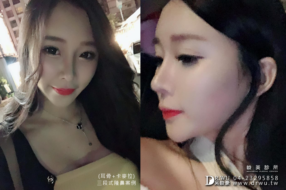 【三段式卡麥拉隆鼻】韓式隆鼻+自體耳軟骨隆鼻,創造亞洲美鼻~|臉部自體脂肪補脂|峻美診所