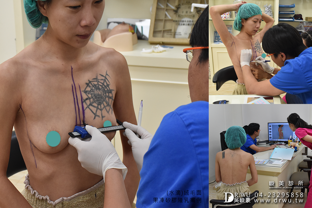 【水滴型隆乳】隆乳手術過程,Tina女神來分享|水滴型果凍矽膠隆乳|峻美診所