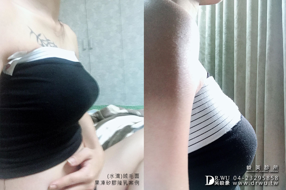 【水滴型隆乳】隆乳手術過程,Tina女神來分享|水滴型果凍矽膠隆乳|峻美診所
