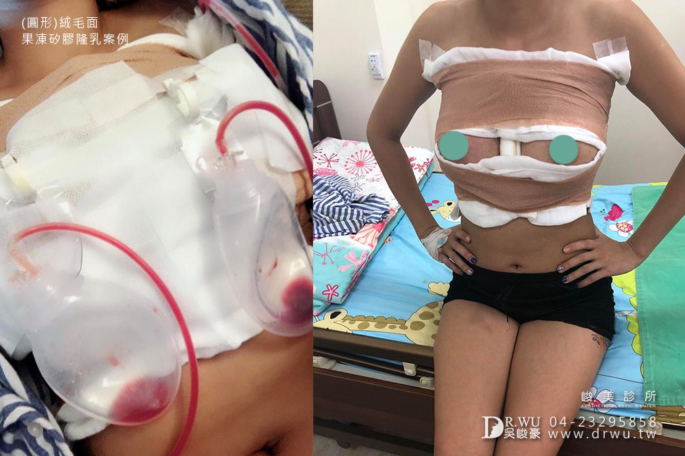 【圓形絨毛面果凍矽膠隆乳】隆乳女神的誘惑,有如自然美、自我美艷感|峻美診所