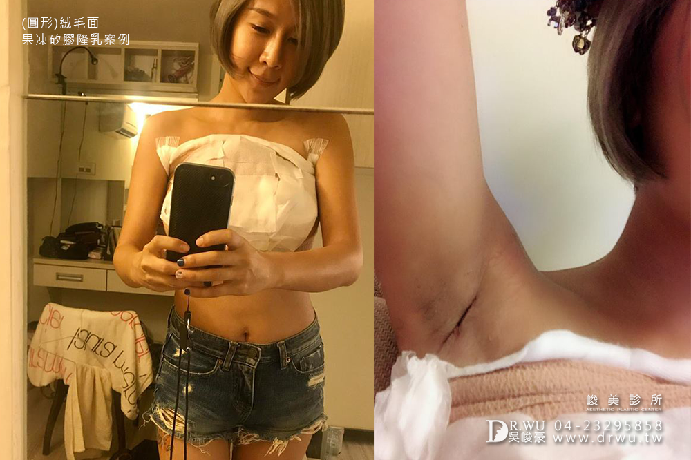 【圓形絨毛面果凍矽膠隆乳】隆乳女神的誘惑,有如自然美、自我美艷感|峻美診所