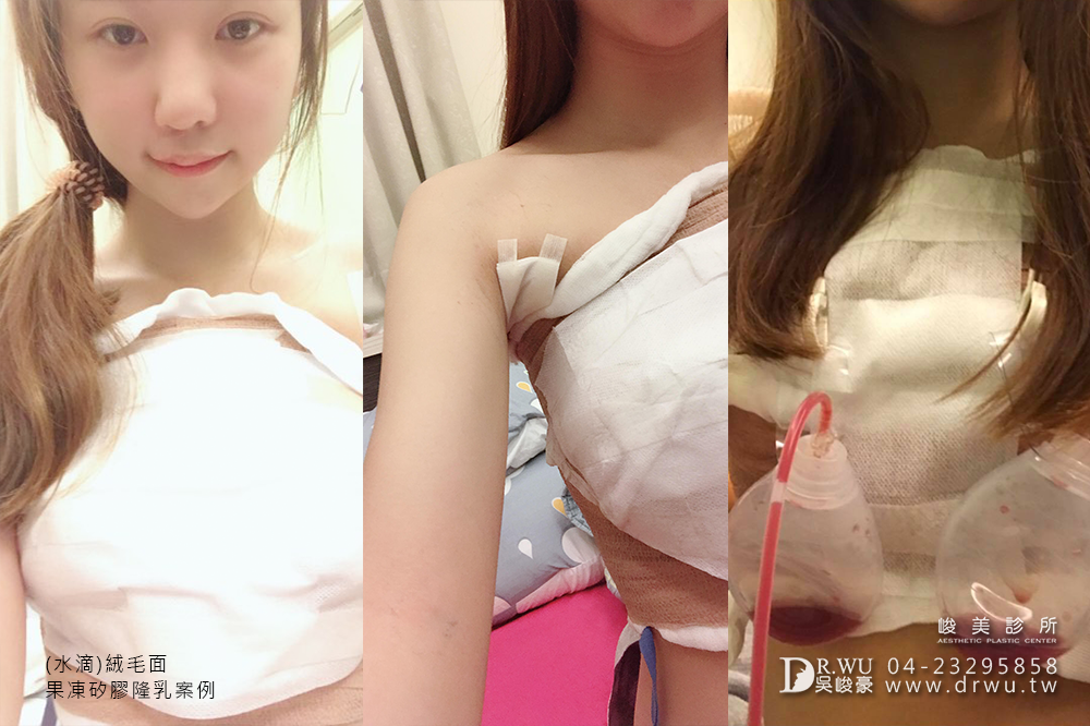 【水滴隆乳案例】水滴隆乳多久自然,答案在這裡|隆乳後遺症就是太美|峻美診所
