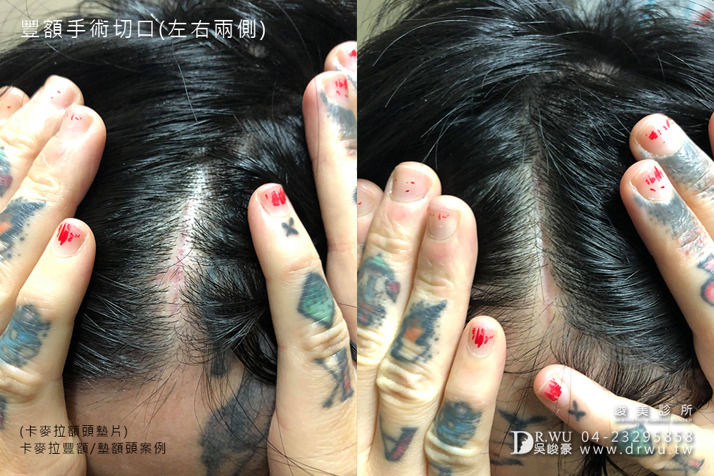 【卡麥拉豐額】台中豐額讓額頭線條更柔和|內視鏡豐額微創傷口 |峻美診所