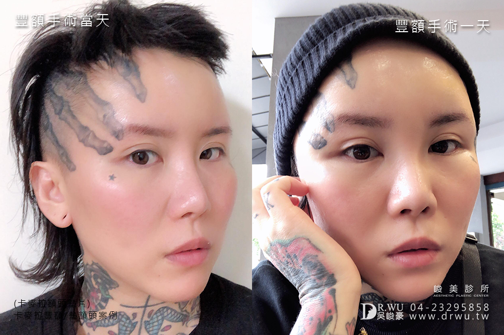 【卡麥拉豐額】台中豐額讓額頭線條更柔和|內視鏡豐額微創傷口 |峻美診所