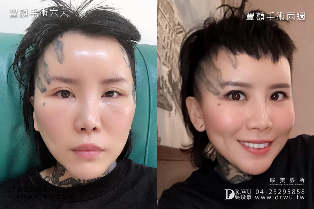 【卡麥拉豐額】台中豐額讓額頭線條更柔和|內視鏡豐額微創傷口 |峻美診所