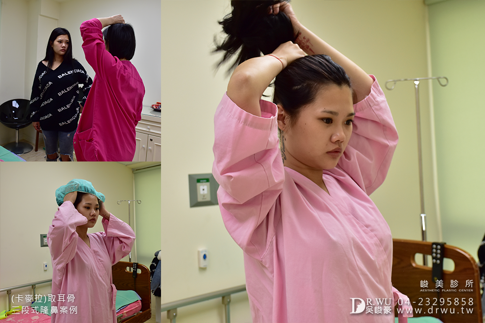 【卡麥拉隆鼻】隆鼻手術一直是我從小到大的願望!|取耳骨三段式隆鼻|峻美診所