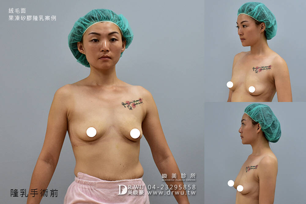 【絨毛面果凍矽膠隆乳】產後胸部變形，隆乳媽咪也可以有少女般的酥胸｜峻美診所