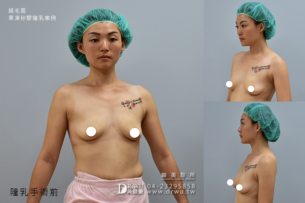 【絨毛面果凍矽膠隆乳】產後胸部變形,隆乳媽咪也可以有少女般的酥胸|峻美診所