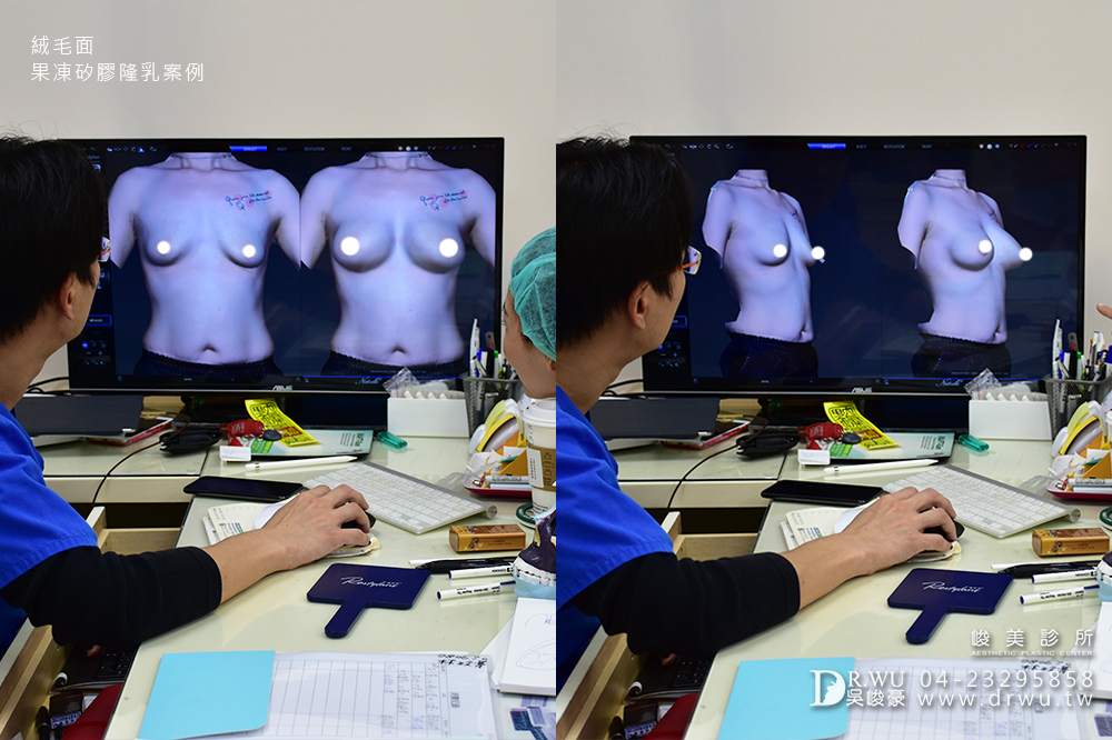 【絨毛面果凍矽膠隆乳】產後胸部變形,隆乳媽咪也可以有少女般的酥胸|峻美診所