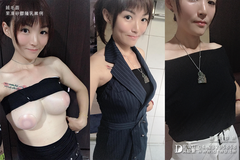 【絨毛面果凍矽膠隆乳】產後胸部變形,隆乳媽咪也可以有少女般的酥胸|峻美診所