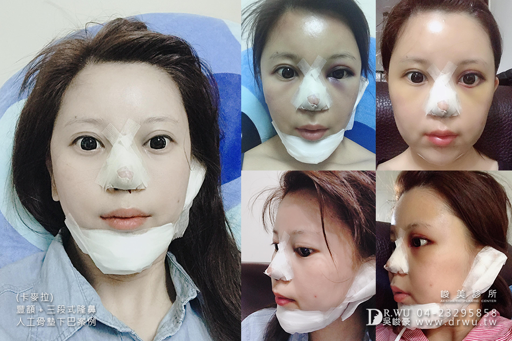 【卡麥拉豐額、卡麥拉三段式隆鼻、人工骨墊下巴】從普通路人晉陞為氣質小姐姐,美的讓人完全心動狙擊!|三種面部手術一次完成|峻美診所
