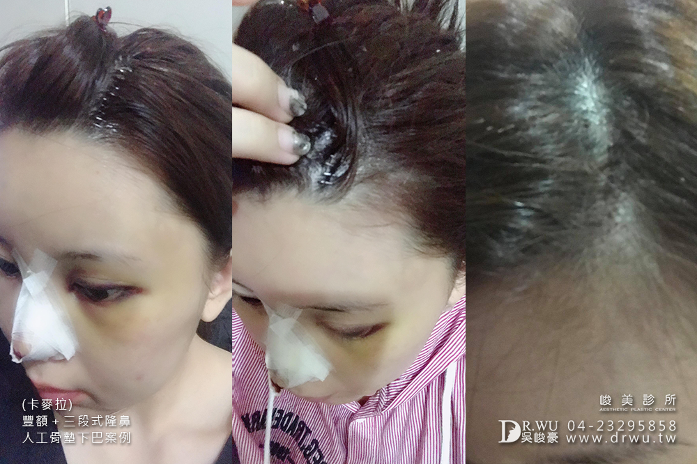 【卡麥拉豐額、卡麥拉三段式隆鼻、人工骨墊下巴】從普通路人晉陞為氣質小姐姐,美的讓人完全心動狙擊!|三種面部手術一次完成|峻美診所