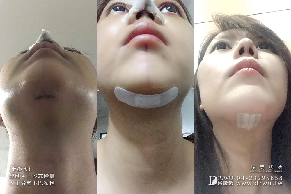 【卡麥拉豐額、卡麥拉三段式隆鼻、人工骨墊下巴】從普通路人晉陞為氣質小姐姐,美的讓人完全心動狙擊!|三種面部手術一次完成|峻美診所